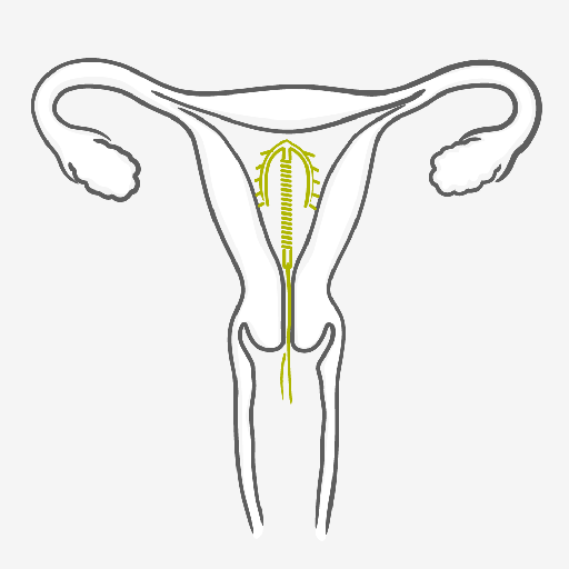 Como usar o Dispositivo Intrauterino - DIU