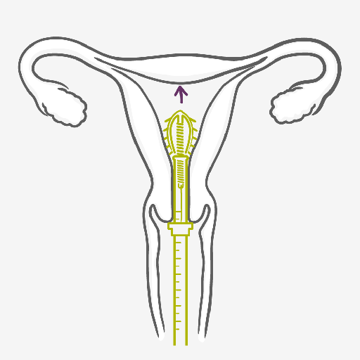 Como usar o Dispositivo Intrauterino - DIU