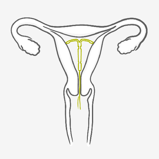 Como usar o DIU Hormonal (SIU)