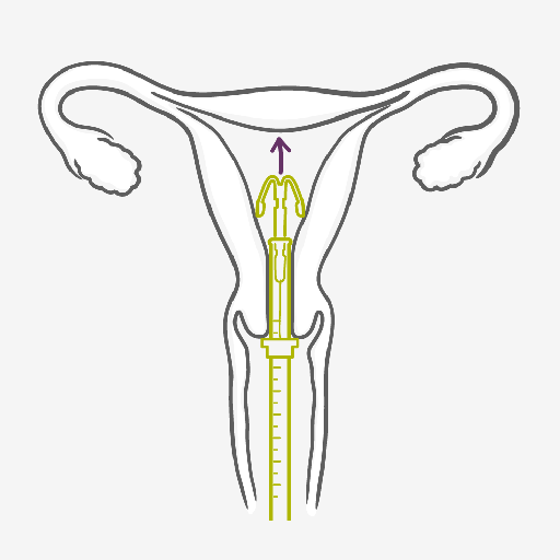 Como funciona o DIU Hormonal (SIU)