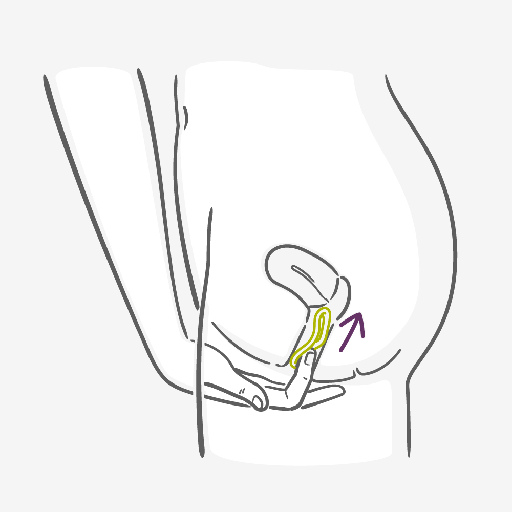 Como inserir o Anel Vaginal