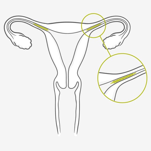 Como funciona a esterilização feminina