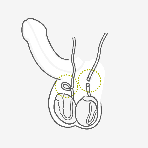 Como funciona a esterilização masculina