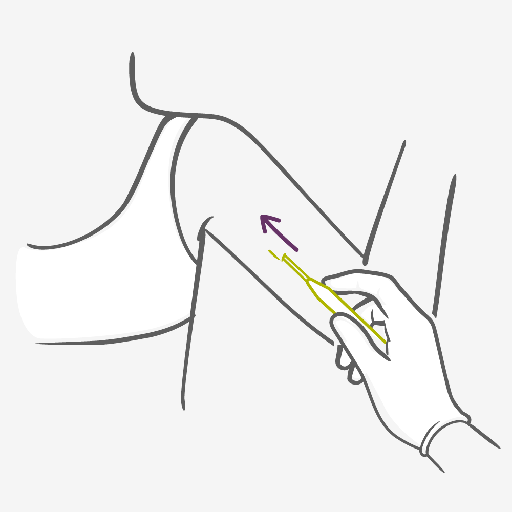 Como usar o Implante Contraceptivo